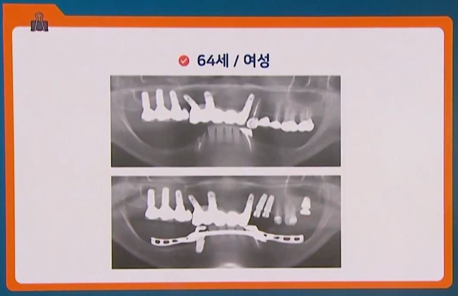 소수 잔존치 사례