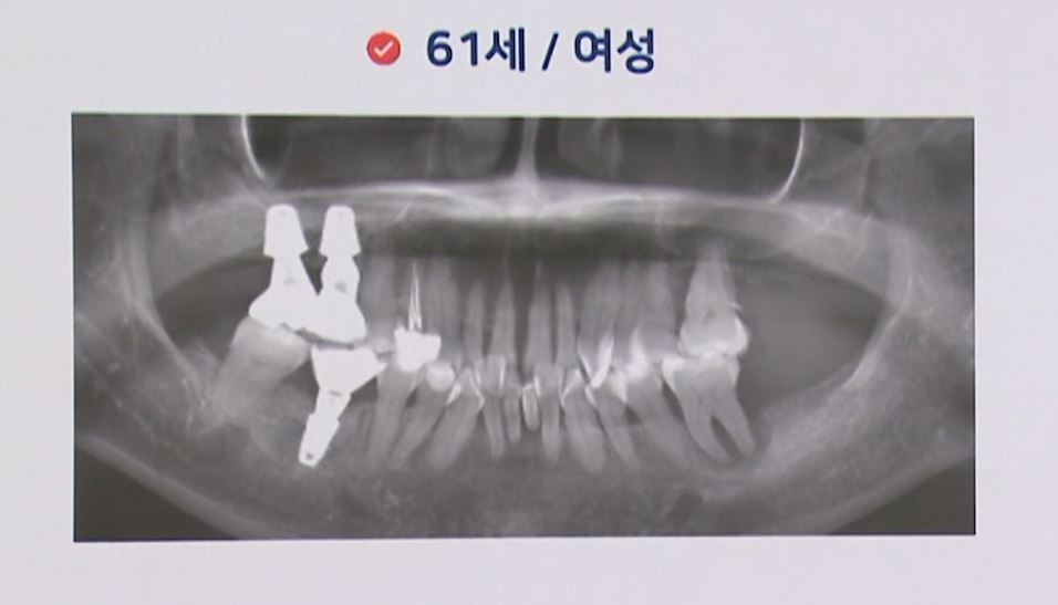 소수 임플란트 사례